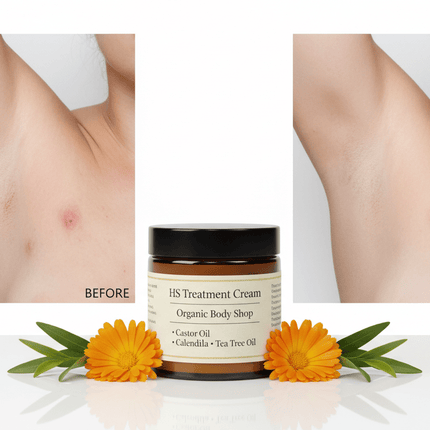 HS treatment cream - Hidradenitis Suppurativa. - Just Simcoe