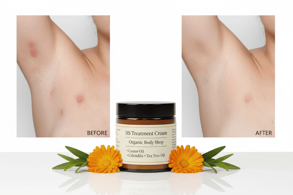 HS treatment cream-Hidradenitis Suppurativa.